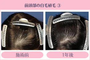 20代 女性 N.S.さん／前頭部 自毛植毛（MIRAI法）／1,000株の症例
