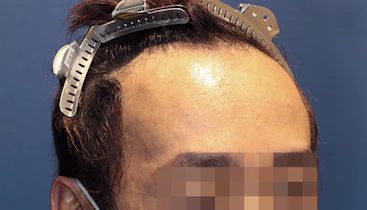 40代 男性 Y.N.さん 生え際 自毛植毛（MIRAI法）1,600株の症例｜自毛植毛の症例（手術前）