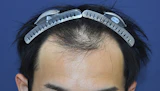 20代 男性 O.K.さん 生え際 自毛植毛（MIRAI法）2,500株の症例｜自毛植毛の症例（手術前）