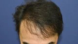 50代 男性 Y.S.さん 生え際 前頭部 自毛植毛（MIRAI法）2,400株の症例｜自毛植毛の症例（手術後）