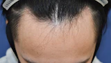 20代 男性 N.S.さん 生え際 自毛植毛（MIRAI法）1,500株の症例｜自毛植毛の症例（手術前）