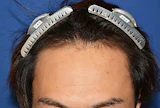 30代 男性 H.T.さん 生え際 自毛植毛（MIRAI法）1,500株の症例｜自毛植毛の症例（手術前）