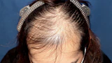 30代 男性 S.S.さん 生え際・前頭部・頭頂部 自毛植毛（MIRAI法）3,300株の症例｜自毛植毛の症例（手術前）