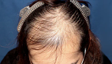 30代 男性 S.S.さん 生え際・前頭部・頭頂部 自毛植毛（MIRAI法）3,300株の症例｜自毛植毛の症例（手術前）