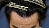 20代 男性 T.T.さん 生え際 自毛植毛（MIRAI法）1,500株の症例｜自毛植毛の症例（手術後）