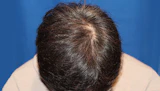 40代 男性 T.N.さん 頭頂部 自毛植毛（MIRAI法）1,600株の症例｜自毛植毛の症例（手術前）