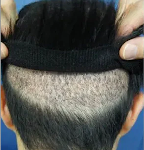 MIRAI法だと、後頭部・側頭部の髪の毛を刈り上げる必要がある