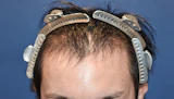 20代 男性 Y.R.さん 生え際 自毛植毛（MIRAI法）1,800株の症例｜自毛植毛の症例（手術前）