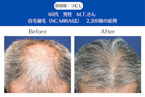 60代 男性 M.T.さん／前頭部・頭頂部・つむじの自毛植毛(MIRAI法)／2,300株の症例