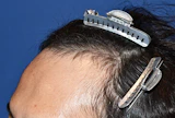 30代 男性 I.N.さん 生え際 自毛植毛（MIRAI法）800株の症例｜自毛植毛の症例（手術前）