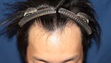 20代 男性 T.E.さん 生え際 自毛植毛（MIRAI法）1,000株の症例｜自毛植毛の症例（手術前）