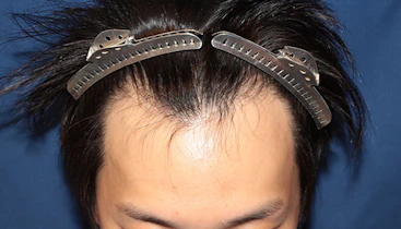 20代 男性 T.E.さん 生え際 自毛植毛（MIRAI法）1,000株の症例｜自毛植毛の症例（手術前）