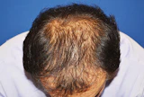 340代 男性 N.T.さん 前頭部・頭頂部 自毛植毛（MIRAI法）2,200株の症例｜自毛植毛の症例（手術前）