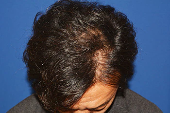 40代 男性 I.M.さん 生え際・頭頂部 自毛植毛（MIRAI法）1,500株（術後1年の経過）