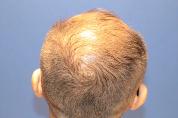 60代 男性 K.Y.さん 頭頂部 自毛植毛（MIRAI法）2,500株の症例｜自毛植毛の症例（手術前）
