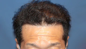 40代 男性 N.T.さん 生え際 自毛植毛（MIRAI法）3,000株の症例｜自毛植毛の症例（2回目手術から4ヶ月後）