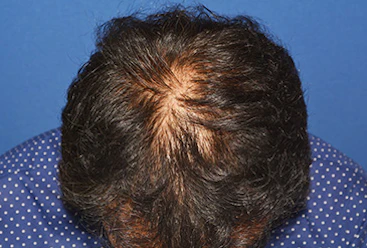 40代 男性 N.T.さん 前頭部・頭頂部 自毛植毛（MIRAI法）2,200株の症例（手術後）