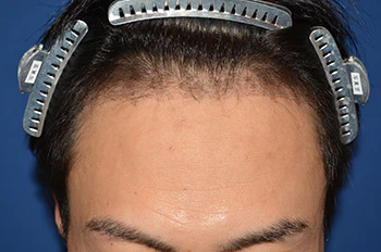 30代 男性 H.T.さん 生え際 自毛植毛（MIRAI法）1,500株の症例｜自毛植毛の症例（術後2ヶ月）