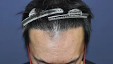 40代 男性 Y.K.さん 生え際・前頭部 自毛植毛（MIRAI法）3,000株の症例｜自毛植毛の症例（手術後）