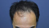 50代 男性 Y.S.さん 生え際 前頭部 自毛植毛（MIRAI法）2,400株の症例｜自毛植毛の症例（手術前）