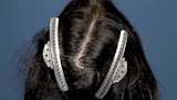 40代 男性  K.A.さん 頭頂部・つむじ 自毛植毛（MIRAI法）600株の症例｜自毛植毛の症例（手術後）