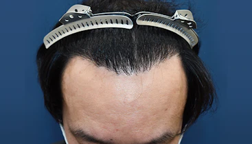 40代 男性  S.T.さん 生え際・前頭部 自毛植毛（MIRAI法）1,800株の症例｜自毛植毛の症例（手術後）
