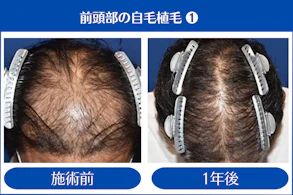 40代 男性 N.Y.さん／前頭部・頭頂部 自毛植毛（MIRAI法）／2,000株の症例