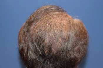 60代 男性 K.Y.さん 頭頂部 自毛植毛（MIRAI法）2,500株の症例｜自毛植毛の症例（手術1年後）