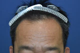 40代 男性 I.S.さん 生え際・前頭部・右こめかみ自毛植毛（MIRAI法）2,800株の症例｜自毛植毛の症例（手術前）