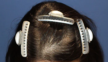 20代 女性 N.S.さん 前頭部 自毛植毛（MIRAI法）1,000株の症例｜自毛植毛の症例（手術前）