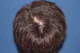 40代 男性 G.N.さん 頭頂部 自毛植毛（MIRAI法）1,200株の症例｜自毛植毛の症例（手術後）
