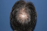 50代 男性 H.K.さん 頭頂部・つむじ 自毛植毛（MIRAI法）2,000株の症例｜自毛植毛の症例（手術後）