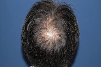 50代 男性 H.K.さん 生え際・頭頂部 自毛植毛（MIRAI法）2,000株の症例｜自毛植毛の症例（術後1年）