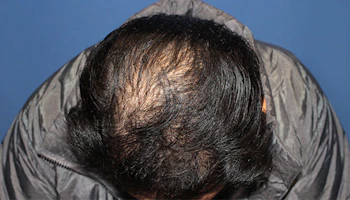 40代 男性 N.T.さん 前頭部・頭頂部 自毛植毛（MIRAI法）3,000株の症例｜自毛植毛の症例（1回目手術から1年後）