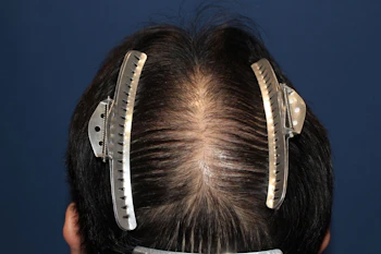 50代 男性 O.Y.さん 頭頂部 自毛植毛（MIRAI法）1,500株の症例｜自毛植毛の症例（手術1年後）