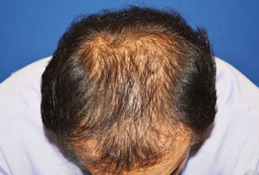 40代 男性 N.T.さん 前頭部・頭頂部 自毛植毛（MIRAI法）2,200株の症例（手術前）