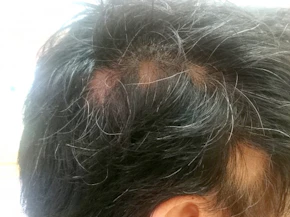 円形脱毛症・瘢痕の治療