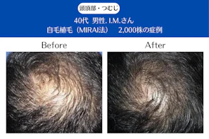 40代 男性 I.M.さん／頭頂部・つむじの自毛植毛(MIRAI法)／2,000株の症例