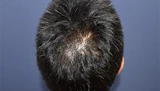 50代 男性 A.Y.さん 頭頂部 自毛植毛（MIRAI法）2,500株の症例｜自毛植毛の症例（手術後）