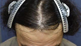 40代 男性  I.K.さん 生え際・前頭部 自毛植毛（MIRAI法）2,800株の症例｜自毛植毛の症例（手術後）