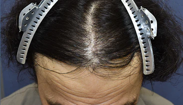40代 男性  I.K.さん 生え際・前頭部 自毛植毛（MIRAI法）2,800株の症例｜自毛植毛の症例（手術後）