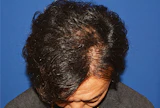 40代 男性 I.M.さん 生え際・頭頂部 自毛植毛（MIRAI法）1,500株の症例｜自毛植毛の症例（手術後）