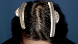 20代 男性 D.H.さん 生え際・頭頂部 自毛植毛（MIRAI法）2,000株の症例｜自毛植毛の症例（手術後）