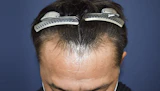 50代 男性 O.S.さん 生え際 自毛植毛（MIRAI法）1,000株の症例｜自毛植毛の症例（手術前）
