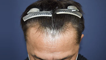 50代 男性 O.S.さん 生え際 自毛植毛（MIRAI法）1,000株の症例｜自毛植毛の症例（手術前）