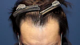 30代 男性 A.K.さん 生え際 自毛植毛（MIRAI法）1,000株の症例｜自毛植毛の症例（手術前）