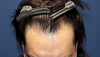 30代 男性 A.K.さん 生え際 自毛植毛（MIRAI法）1,000株の症例｜自毛植毛の症例（手術前）