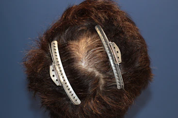 40代 男性 G.N.さん 頭頂部 自毛植毛（MIRAI法）1,200株の症例｜自毛植毛の症例（手術前）
