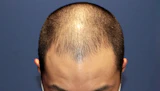20代 男性 M.N.さん 生え際 前頭部 自毛植毛（MIRAI法）1,300株の症例｜自毛植毛の症例（手術前）
