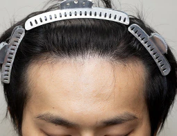 30代男性S.M.さんの生え際写真（施術後）